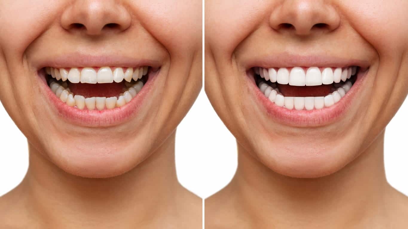 LumiSmile® Teeth Whitening Strips - 14 strips/ Box