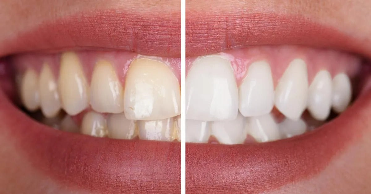 LumiSmile® Teeth Whitening Strips - 14 strips/ Box