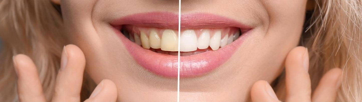 LumiSmile® Teeth Whitening Strips - 14 strips/ Box